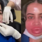 उर्फी जावेद ने हटवाए लिप फिलर्स, सूजे चेहरे के साथ शेयर किया दर्दभरा वीडियो – सोशल मीडिया पर वायरल