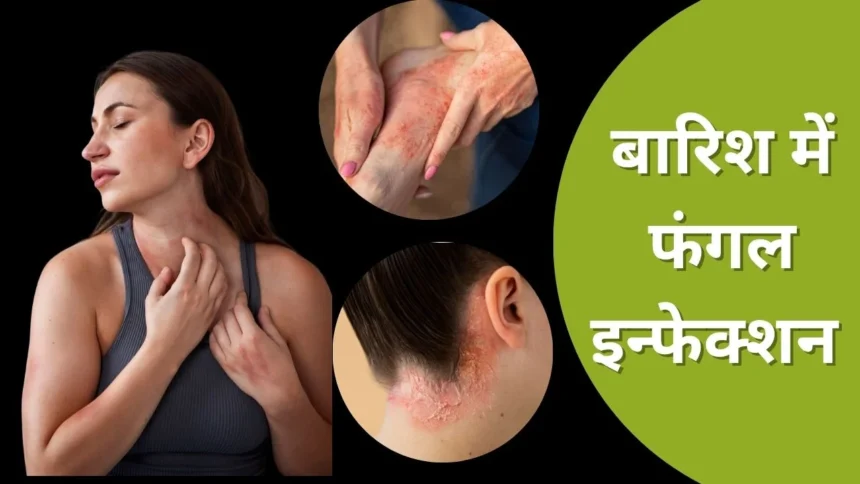 मानसून में त्वचा संक्रमण से बचने के उपाय – डॉक्टर की सलाह
