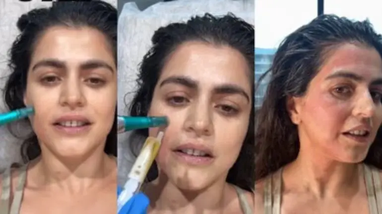 vampire-facial-apna-khoon-chehre-par-fayde-process-cost
